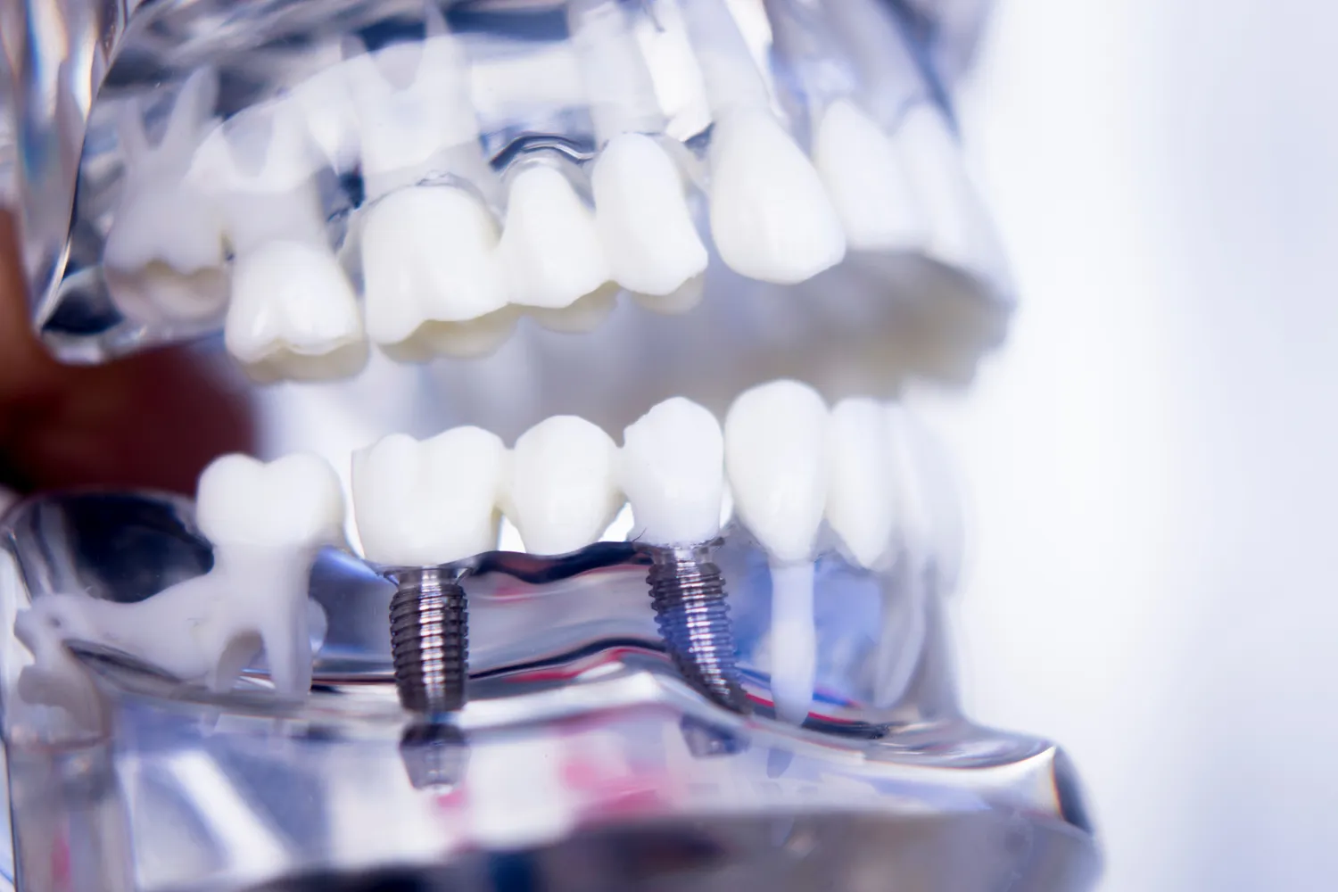 Rodzaje implantów zębowych