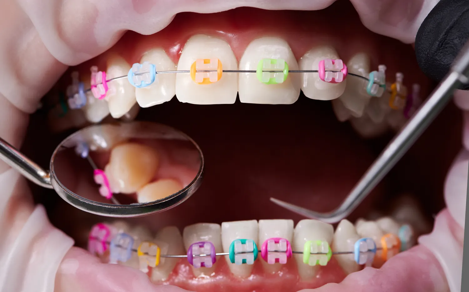 Implanty dentystyczne - czy mogą zastąpić prawdziwe zęby?
